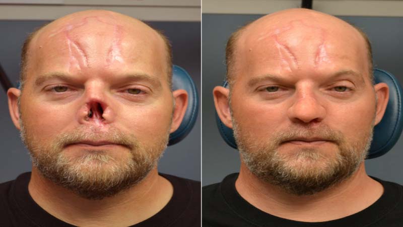 Cancer Patient with destroyed Nose recovers with 3D Printing