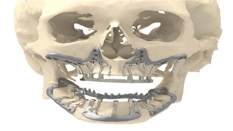 CADskills Titanium 3D Printed Implants is the solution to Bone Atrophy