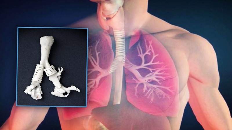 Trachea Without Tissue Scaffolds 3D Printing Advancements
