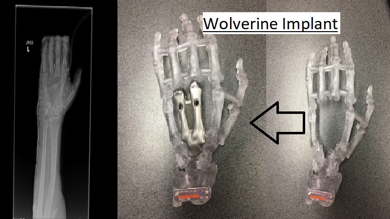 Man Gets Wolverine Like 3D Printed Titanium Metacarpal Implant