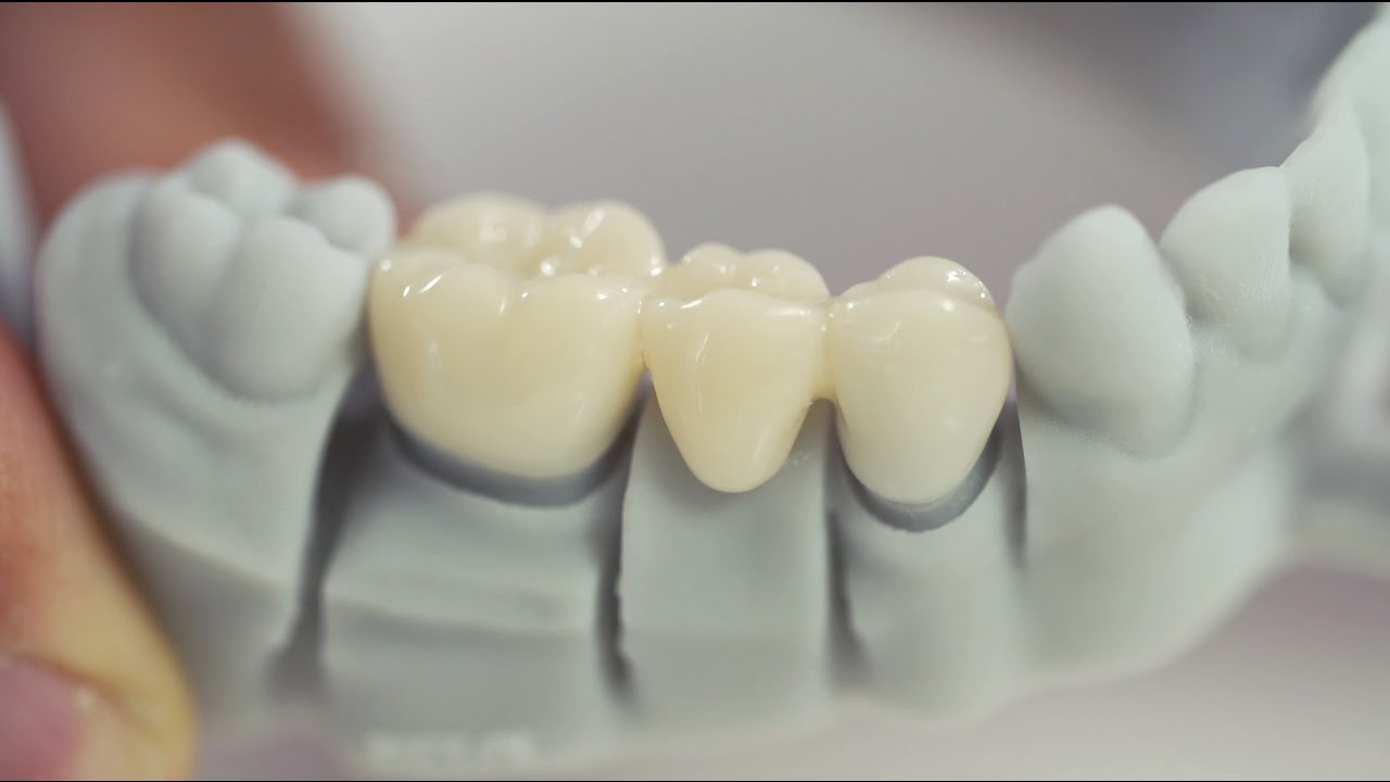 Researchers Work On New High Resolution 3D Printing Process Called TCMIP SL For Dental Crowns