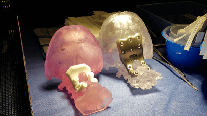 Anatomics Lead Ways Through Patient Specific 3D Printed Spinal To Help People In Need