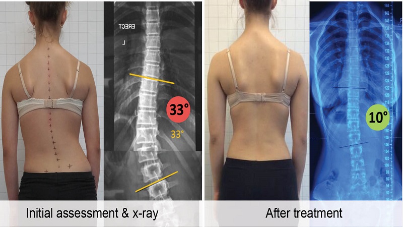 Surgery For Scoliosis Gets Even Better