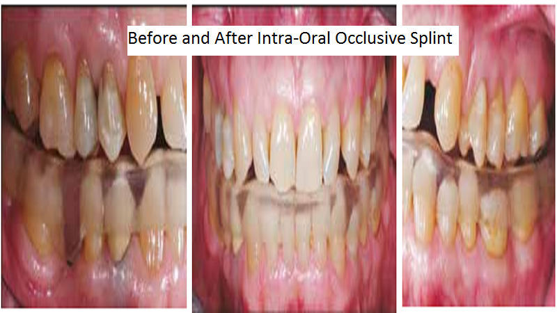 3D Printed Intra Oral Splint Used To Relieve Jaw Pain