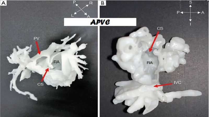 3D Printed Surgical Models Provide Insights To Rare Congenital Heart Disease