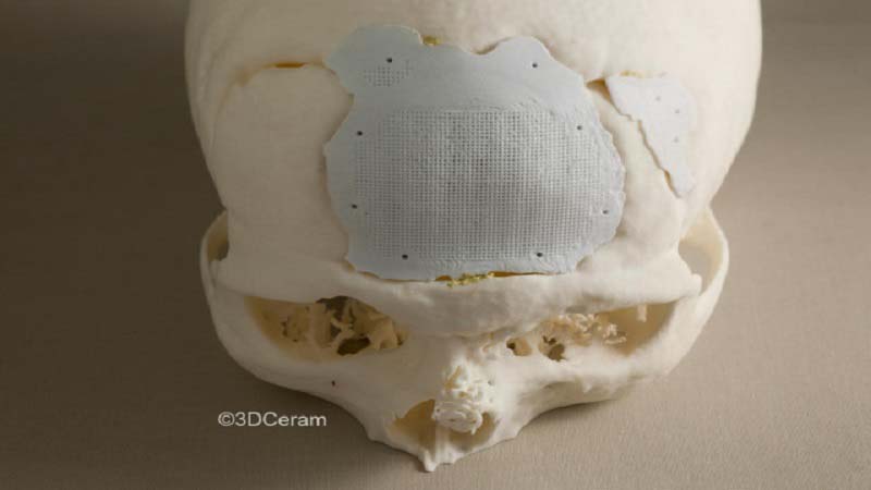 3D Printed Cranial Implants by 3DCeram
