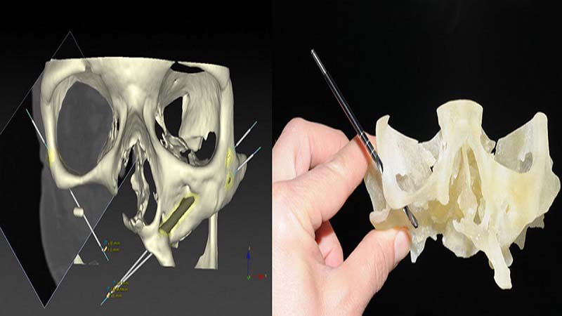 3D Print Entire Jaw