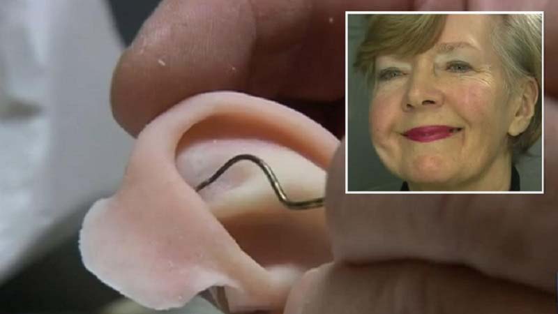 Aussie woman receives 3d printed Ear