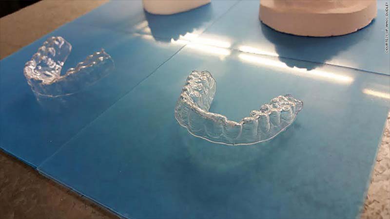 Student 3D Prints OrthoPrints for Teeth Aligment