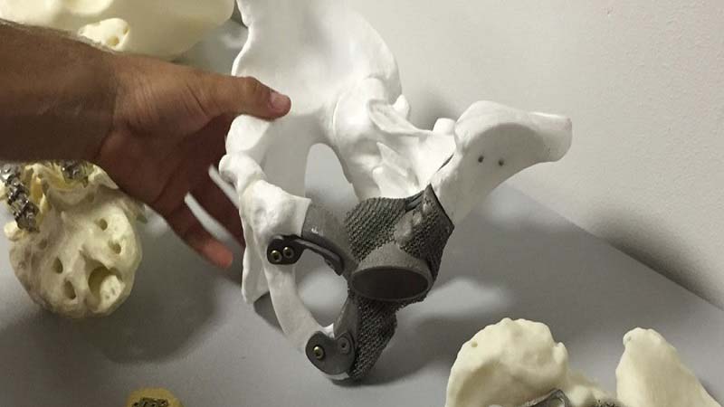 3d print italy cancer implants