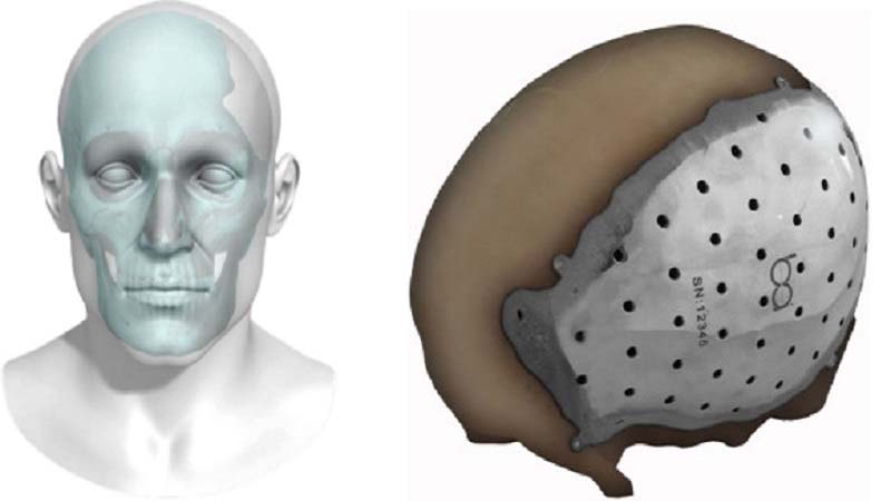 BioArchitects 3D printed titanium cranial plate grabs FDA approval