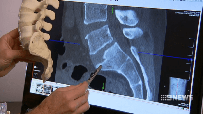 3d print spinal implant australia