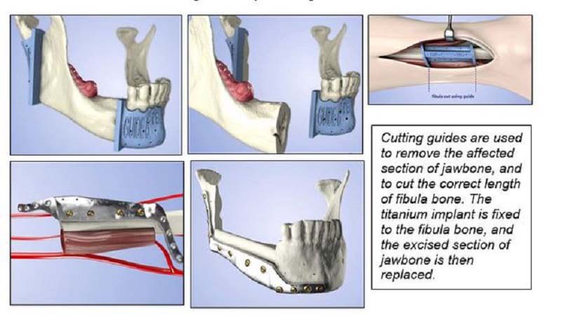 3d printed jaw implant bone graft
