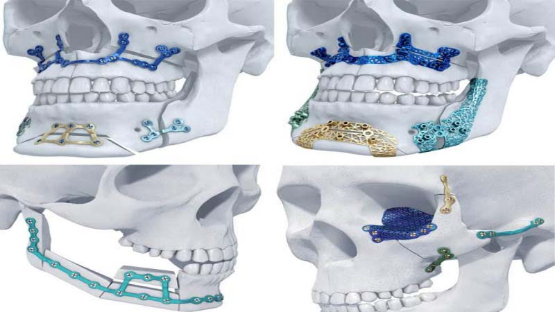 Materialises 3D Printed Titanium Maxillofacial Implants Approved for US Market