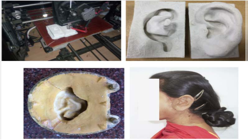 Researchers in India develop 3D Printing Software to create Prosthetic Ear in just one week
