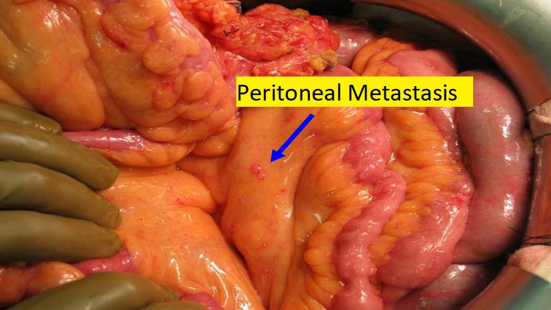 Researchers Work Towards Building Medical Models for Peritoneal Cancer