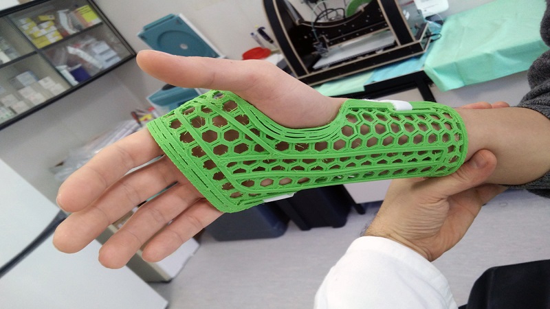 Study Proves 3D Printed Splints Preferable Over Conventional Splints