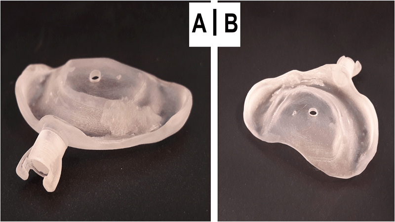 Treatment Of Cleft Lip And Palate Of Newborn Receives Aid From 3D Printing