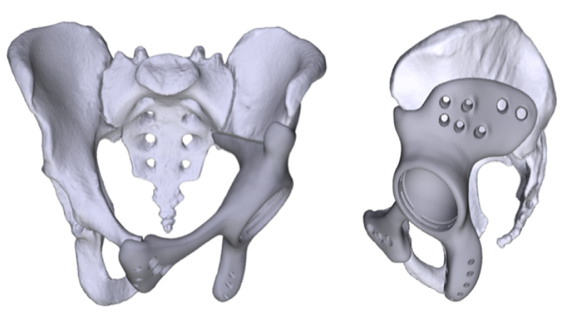 3D Printing Help Indian Surgeons Create Custom Pelvic Implant For Bone Tumor