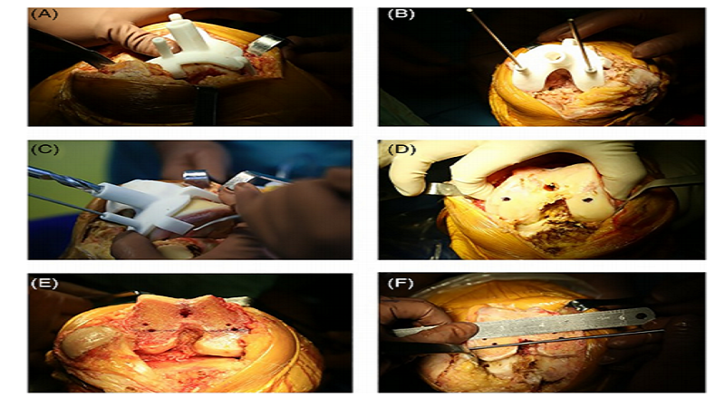 Patient Specific Guides With 3D Printing Outperform Traditional Total Knee Arthroplasty