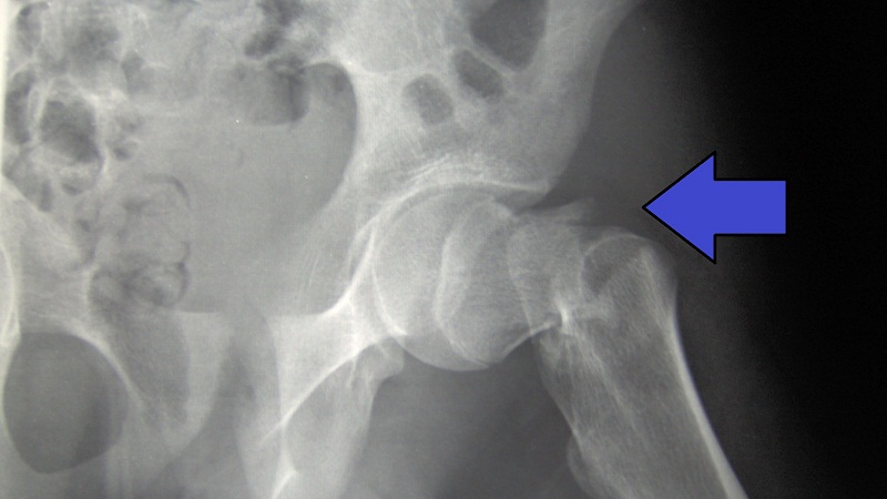 Blood Loss And Surgery Time In Hip Fractures Reduced Using 3D Printed Models
