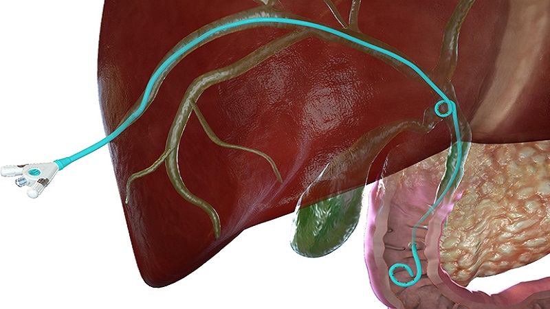 Innovative 3D Printing With PVA Starts With Liver Stenting