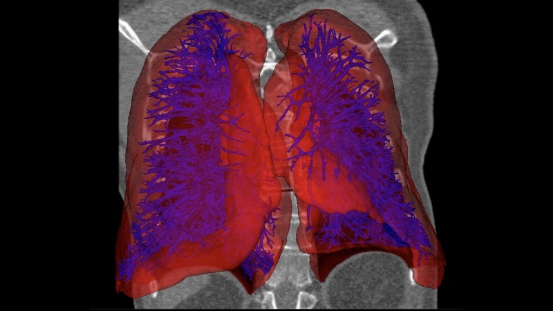 Pioneering 3D Printed Lungs For Veterans Using 3D Printing
