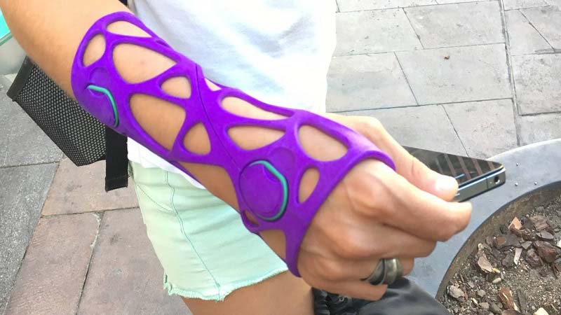 3D Printed Cast are Modern but may not be Cheap