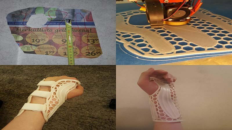 Reddit User 3D Prints his own Custom Brace after breaking Hand