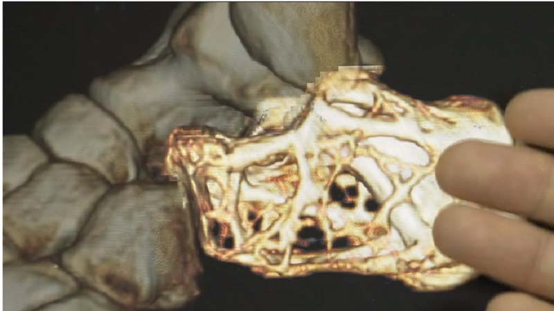 Heel bone Surgery 3D Printed Implant