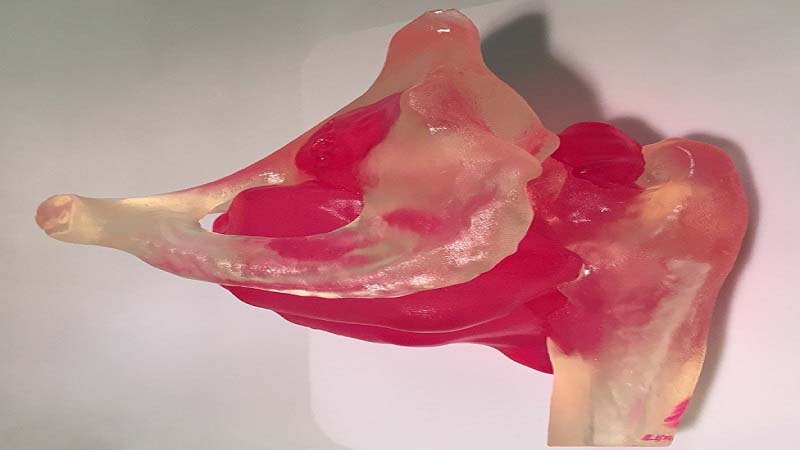 Oncos Surgical 3D Print Cancer